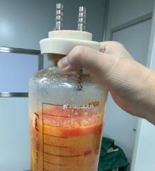 黑龙江水动力吸脂手术要做多久？